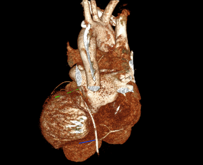 Cardiac strangulation from redundant pacemaker lead
